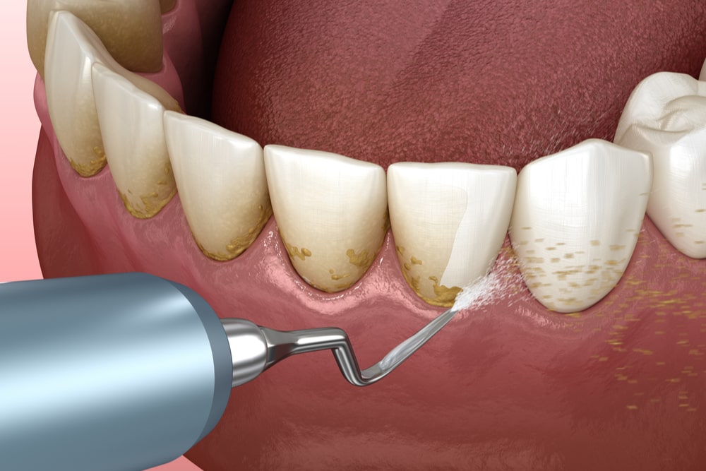 3D illustration of human teeth treatment