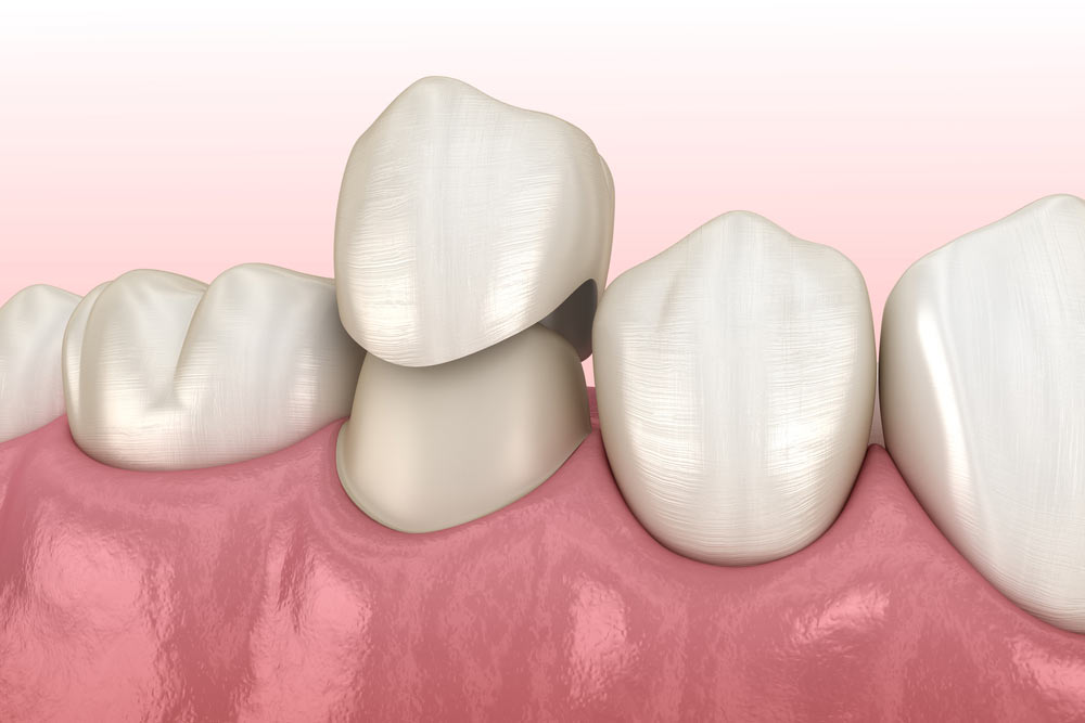 Premolar tooth and dental crown placement
