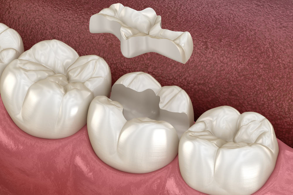 Inlay ceramic crown fixation over tooth